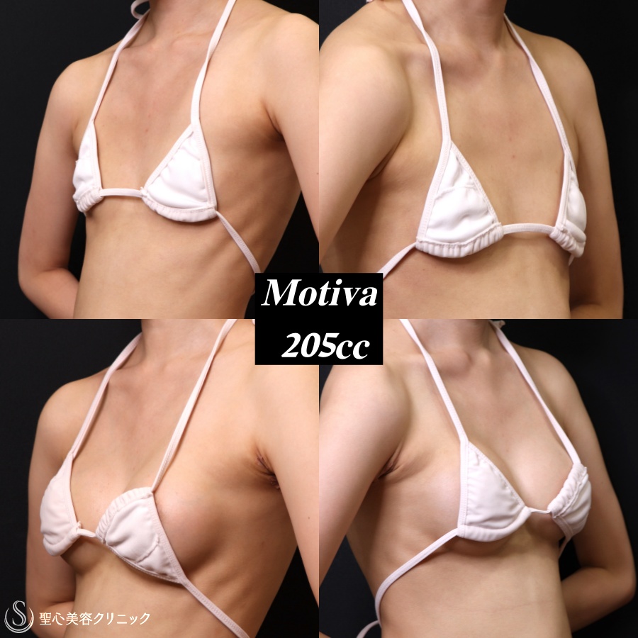 【20代女性・痩せ型】バッグプロテーゼ挿入法（Motiva）（1ヶ月後） After 