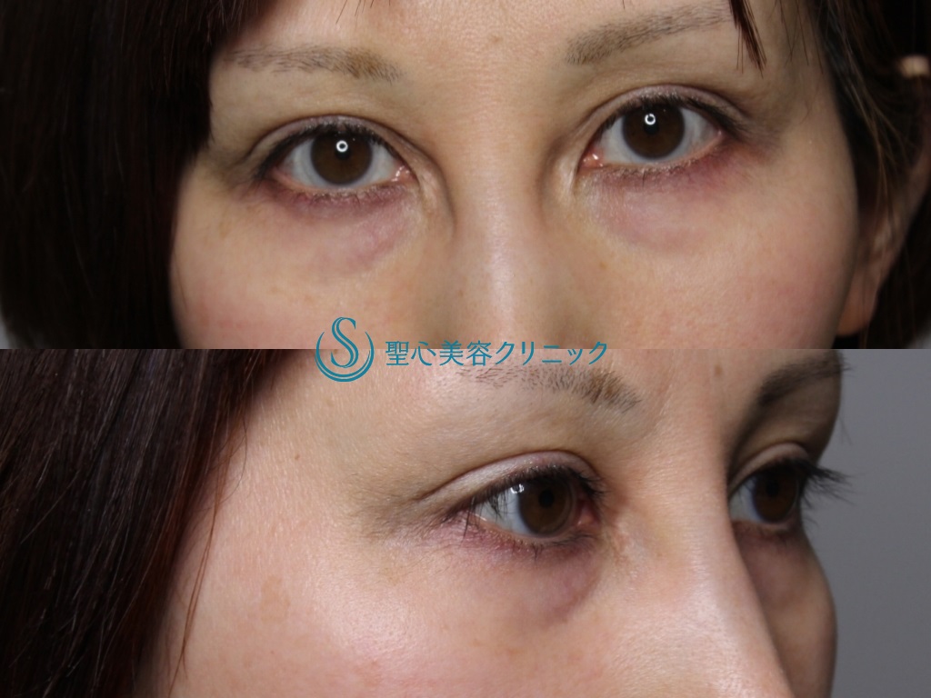 【40代女性・二重ラインをスッキリと】眉下切開+目上切開+目の下プレミアムPRP皮膚再生療法（1ヶ月後） Before 