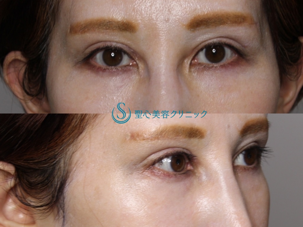 【40代女性・二重ラインをスッキリと】眉下切開+目上切開+目の下プレミアムPRP皮膚再生療法（1ヶ月後） After 