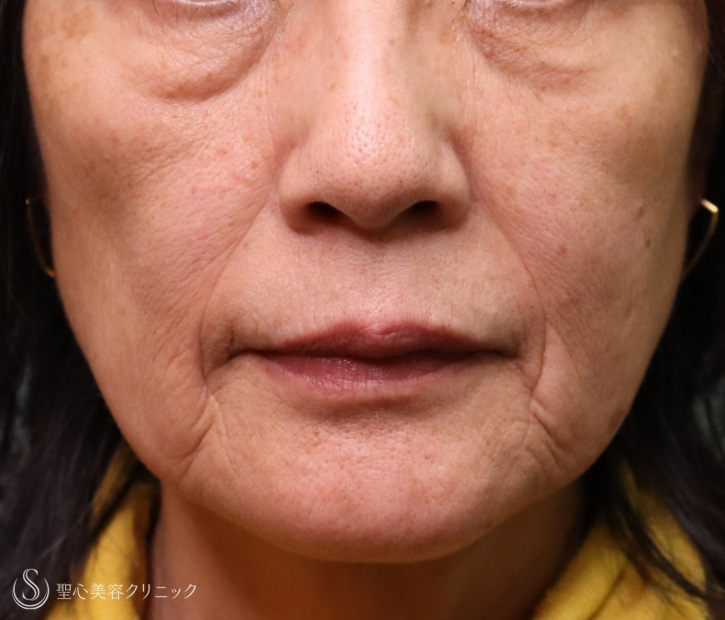 【60代女性・若返り】プレミアムPRP皮膚再生療法（1年6ヶ月後） Before 