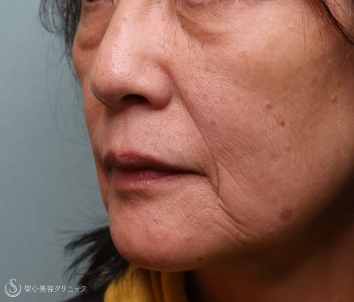 【60代女性・若返り】プレミアムPRP皮膚再生療法（1年6ヶ月後） Before 