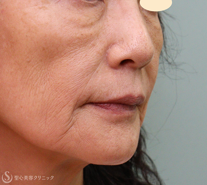 【60代女性・若返り】プレミアムPRP皮膚再生療法（1年6ヶ月後） After 