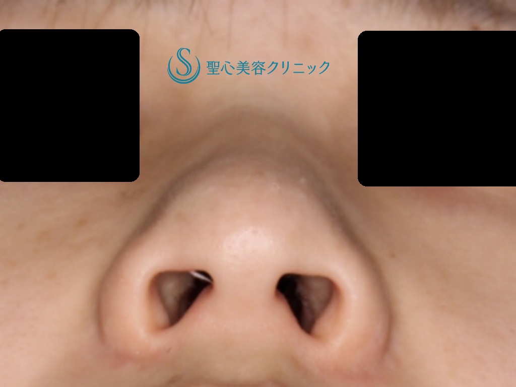 【20代女性・小鼻を小さく目立たなくしたい】小鼻縮小（1ヶ月後） Before 