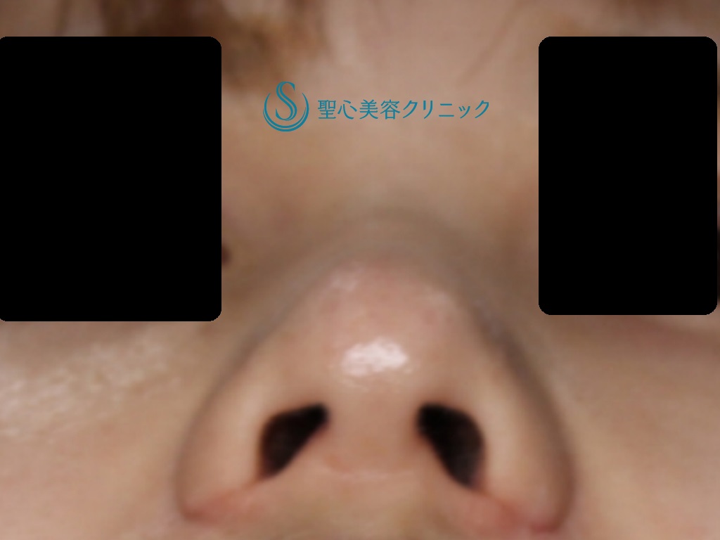 【20代女性・小鼻を小さく目立たなくしたい】小鼻縮小（1ヶ月後） After 