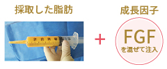 プレミアムLipoLife（ライポライフ）脂肪注入豊胸術