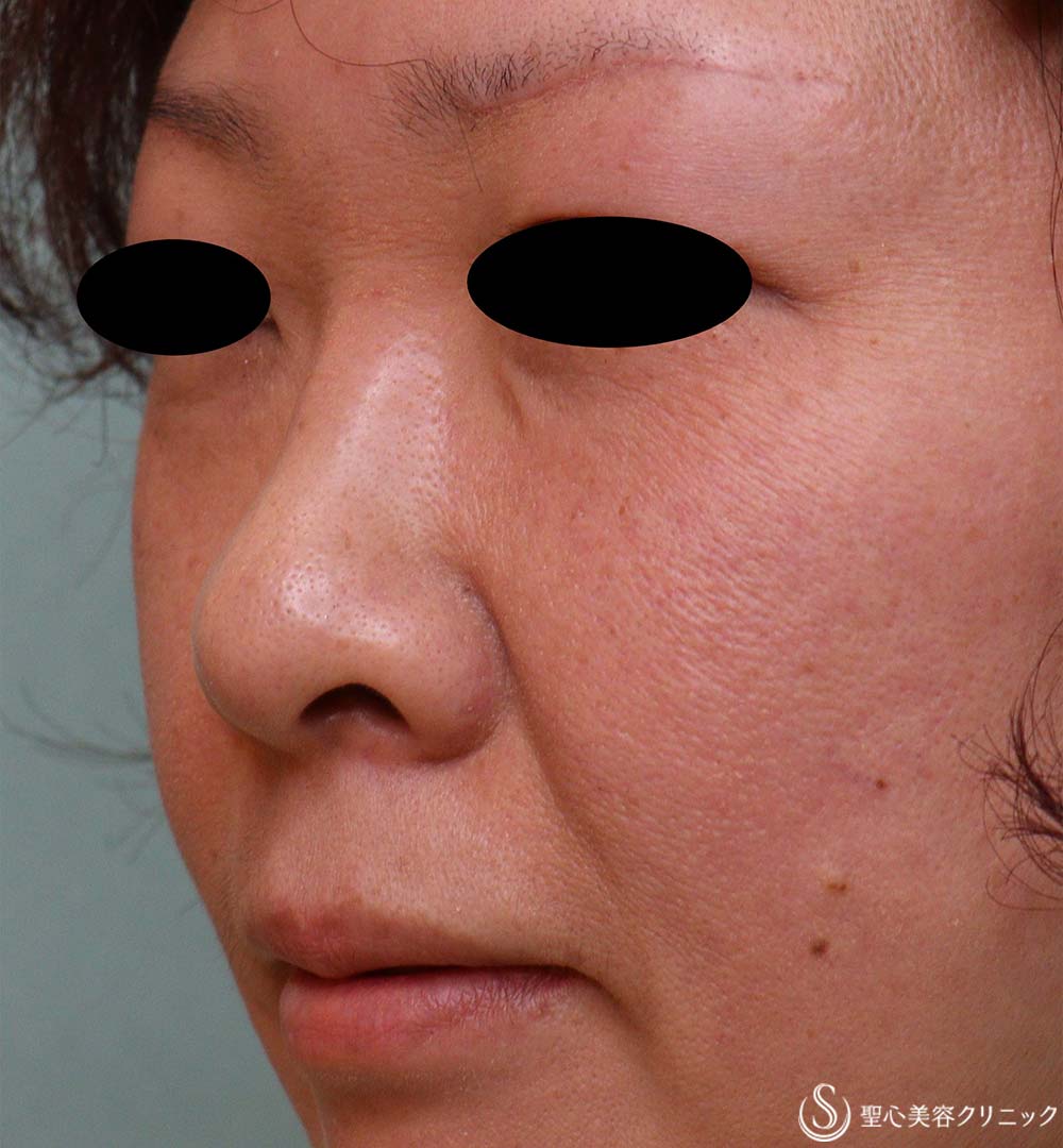 【40代女性・鼻孔の形】鼻孔縁下降術（3ヶ月後） Before 