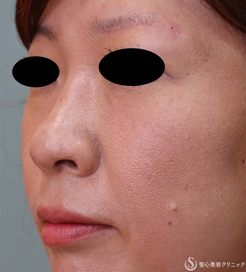 【40代女性・鼻孔の形】鼻孔縁下降術（3ヶ月後） After 