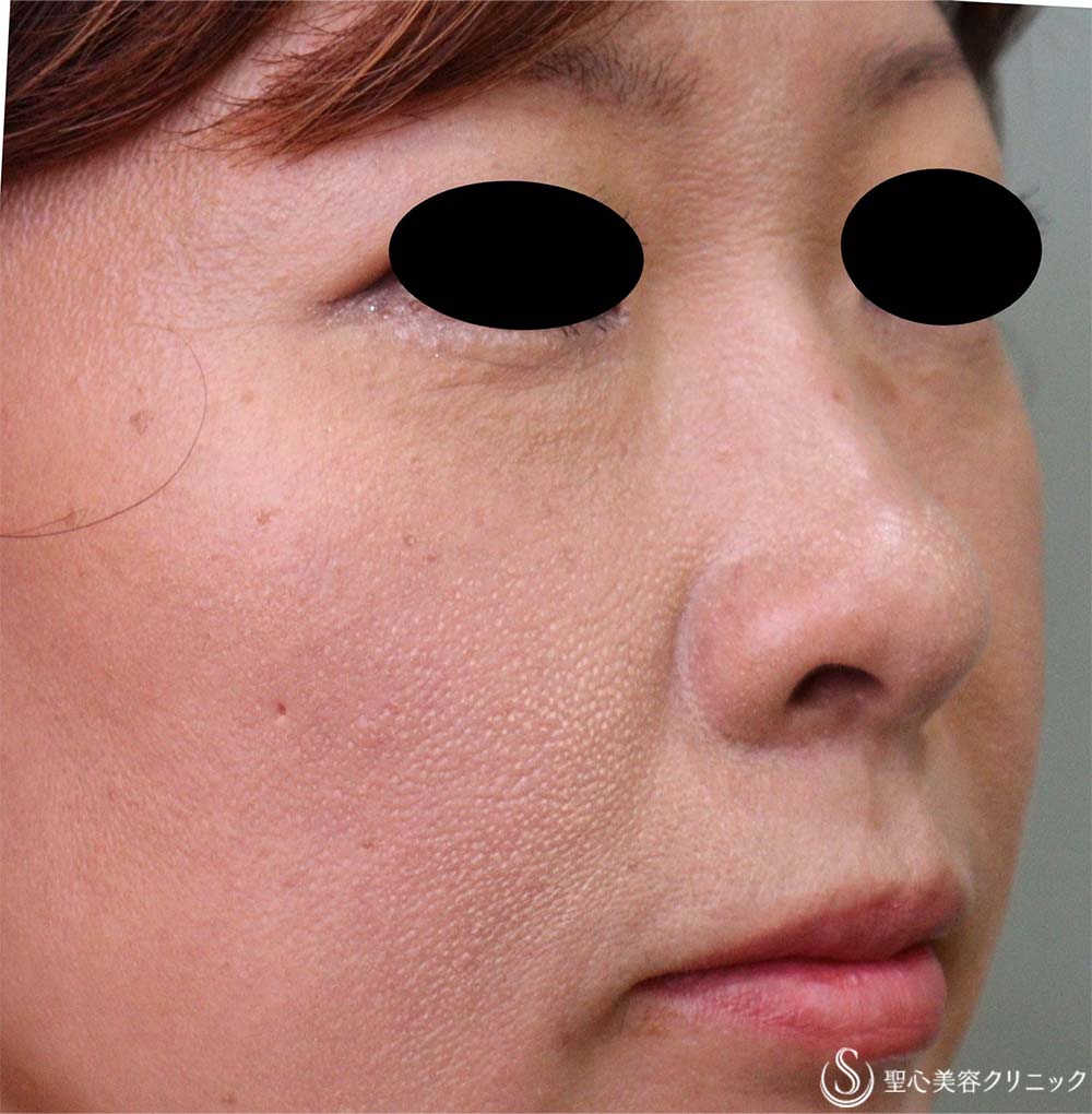 【40代女性・鼻孔の形】鼻孔縁下降術（3ヶ月後） After 