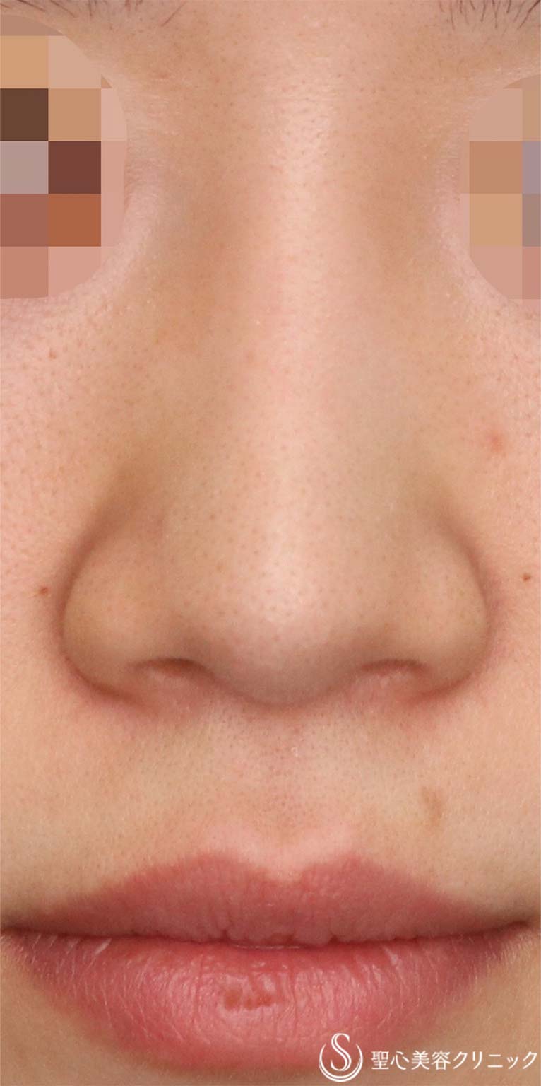 【30代女性・鼻先を整形感が出ないようにナチュラルにスッキリ！！】鼻尖縮小術＋耳介軟骨移植（1ヶ月後） Before 