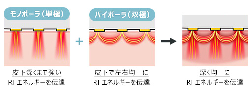 モノポーラ（単極）:皮下深くまで強いRFエネルギーを伝達＋バイポーラ（双極）:皮下で左右均一にRFエネルギーを伝達→深く均一にRFエネルギーを伝達