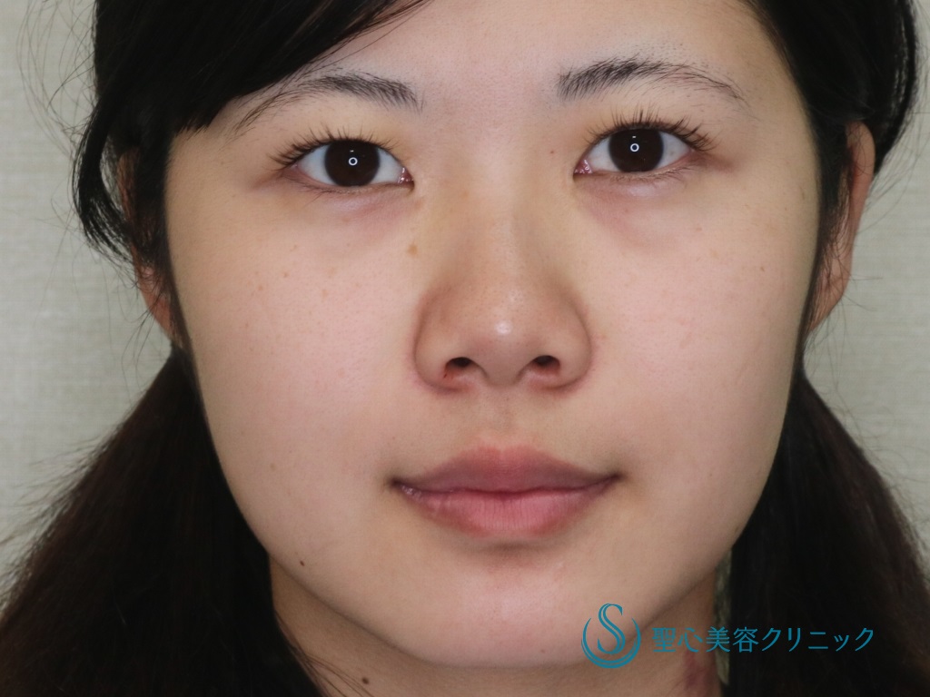 【20代女性・綺麗な二重、小鼻・鼻先の改善】眉下切開＋小鼻縮小+鼻尖縮小+鼻尖形成（３DPCLドーム）（術後1年） Before 