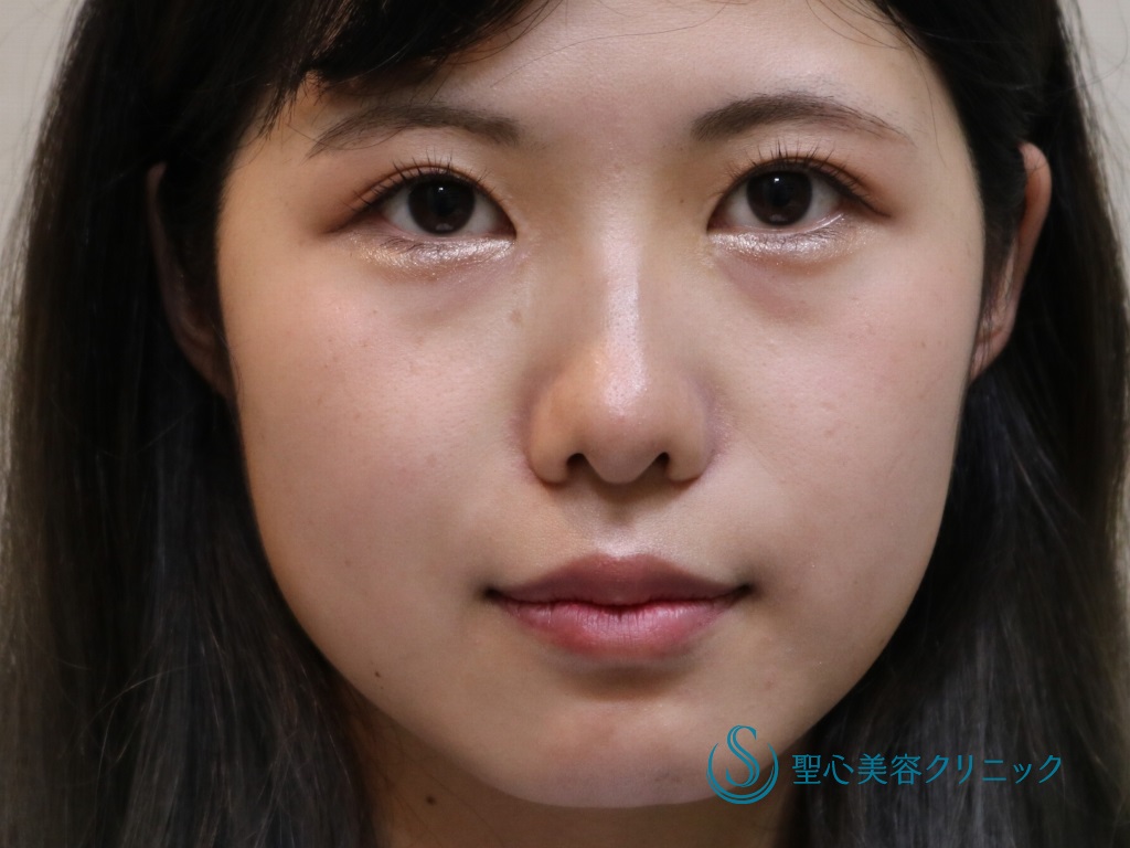 【20代女性・綺麗な二重、小鼻・鼻先の改善】眉下切開＋小鼻縮小+鼻尖縮小+鼻尖形成（３DPCLドーム）（術後1年） After 