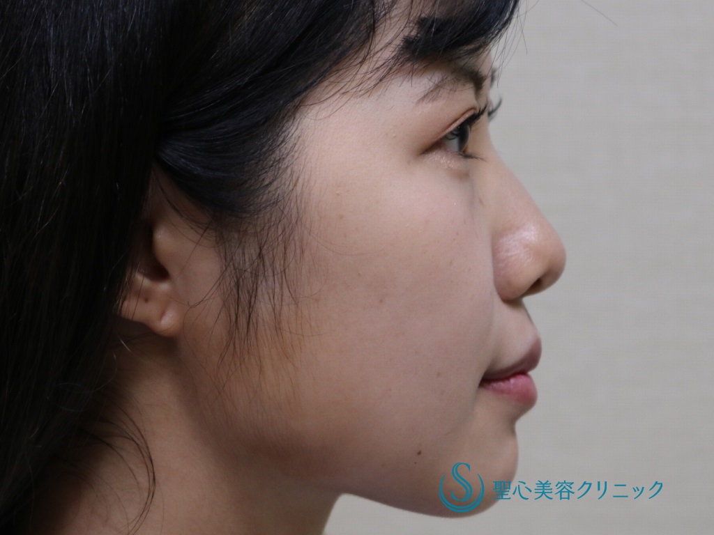【20代女性・綺麗な二重、小鼻・鼻先の改善】眉下切開＋小鼻縮小+鼻尖縮小+鼻尖形成（３DPCLドーム）（術後1年） After 