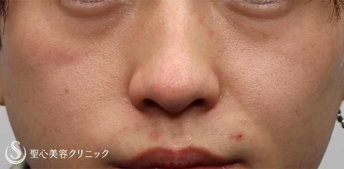 【20代男性・目の下のクマを改善させたい！！】プレミアムPRP皮膚再生療法（1年3ヶ月後） Before 