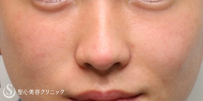 【20代男性・目の下のクマを改善させたい！！】プレミアムPRP皮膚再生療法（1年3ヶ月後） After 