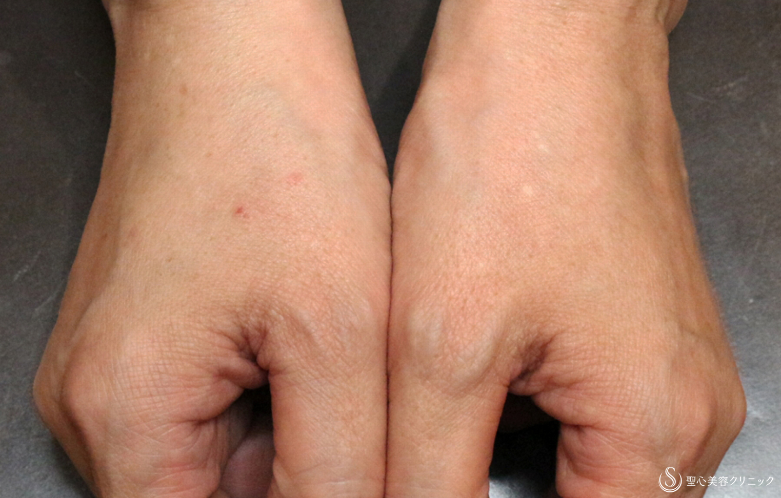 【40代女性・手の甲の若返り】プレミアムPRP皮膚再生療法（10年後） After 