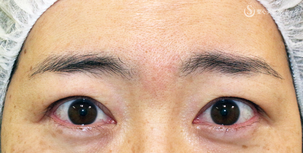 【40代女性・コンタクトレンズ眼瞼下垂にお勧め】切らない眼瞼下垂+α法（術直後〜1年後） After 