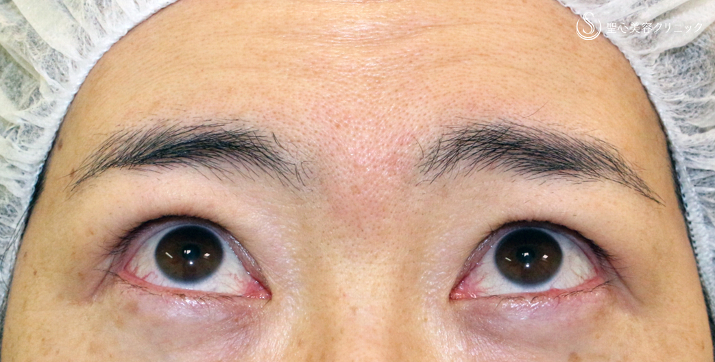 【40代女性・コンタクトレンズ眼瞼下垂にお勧め】切らない眼瞼下垂+α法（術直後〜1年後） After 