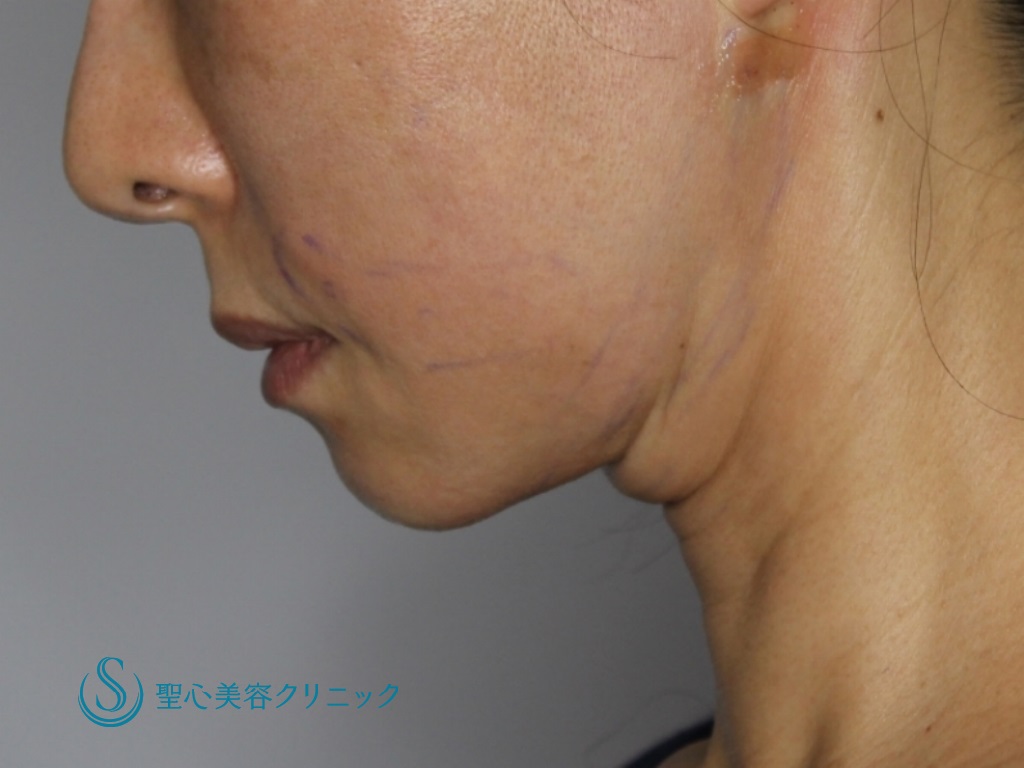 【40代女性・フェイスラインをすっきり】頬アンカーマックス+あご下アンカーDXダブル+あごクレヴィエル（直後） After 
