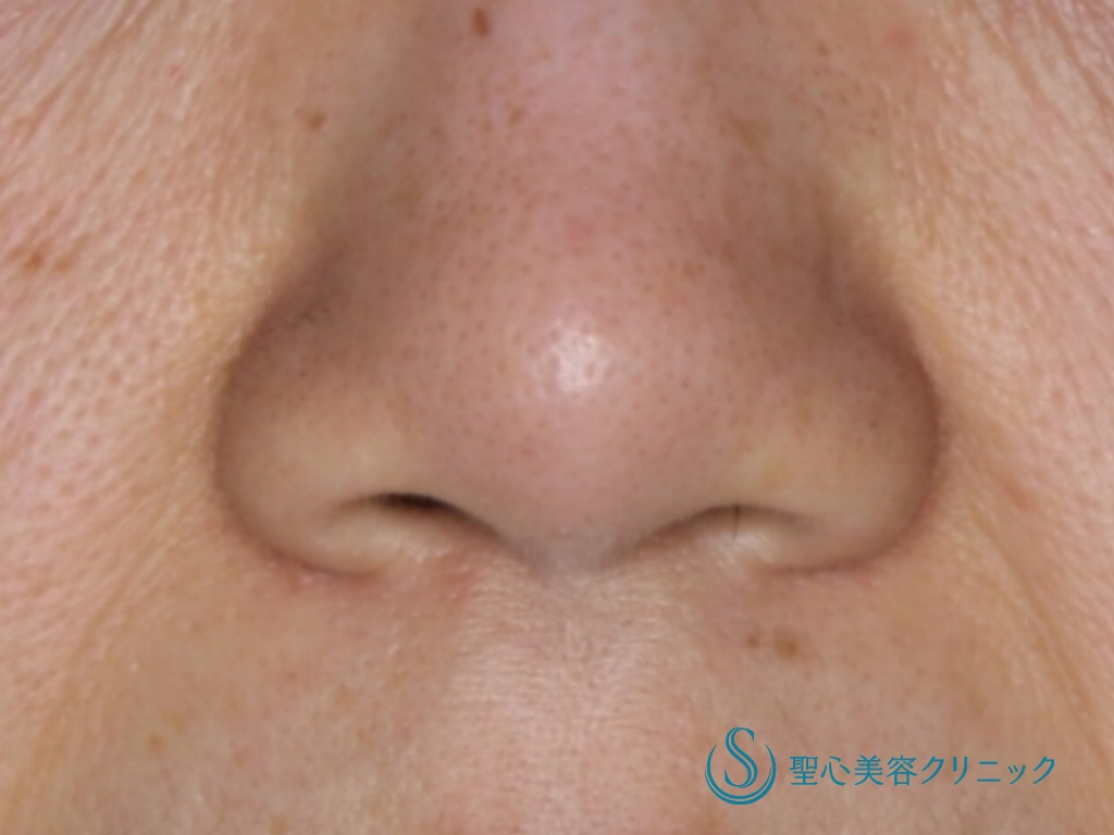 【50代女性・丸く短い鼻先を改善】鼻尖縮小＋鼻尖形成（耳介軟骨移植）（術後1ヶ月） Before 