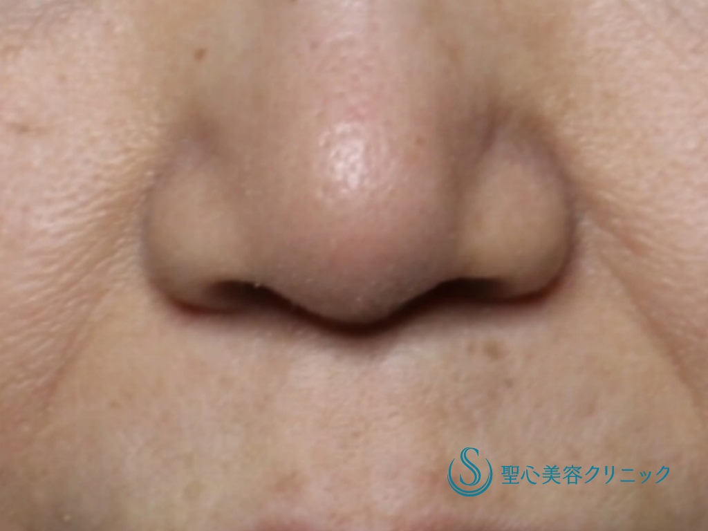 【50代女性・丸く短い鼻先を改善】鼻尖縮小＋鼻尖形成（耳介軟骨移植）（術後1ヶ月） After 