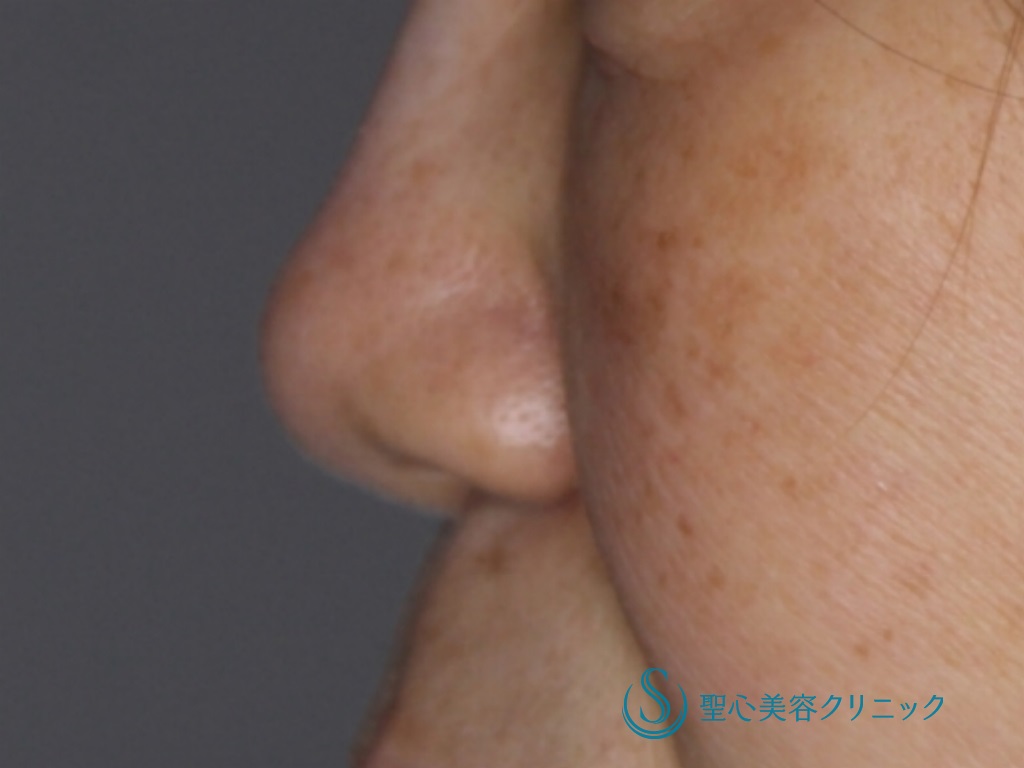 【50代女性・丸く短い鼻先を改善】鼻尖縮小＋鼻尖形成（耳介軟骨移植）（術後1ヶ月） Before 