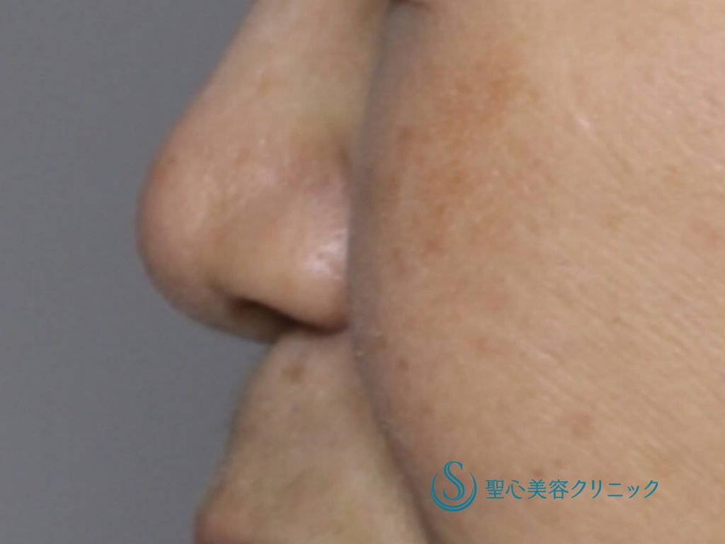 【50代女性・丸く短い鼻先を改善】鼻尖縮小＋鼻尖形成（耳介軟骨移植）（術後1ヶ月） After 