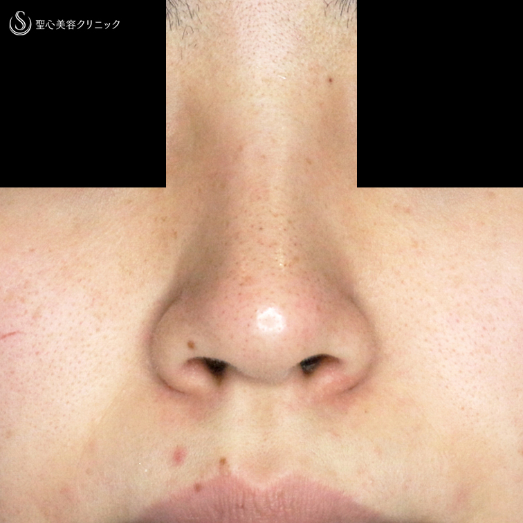 【20代女性・鼻の穴が見えない「忘れ鼻」へ】小鼻縮小術+α法「Ver.5」（4年後） Before 