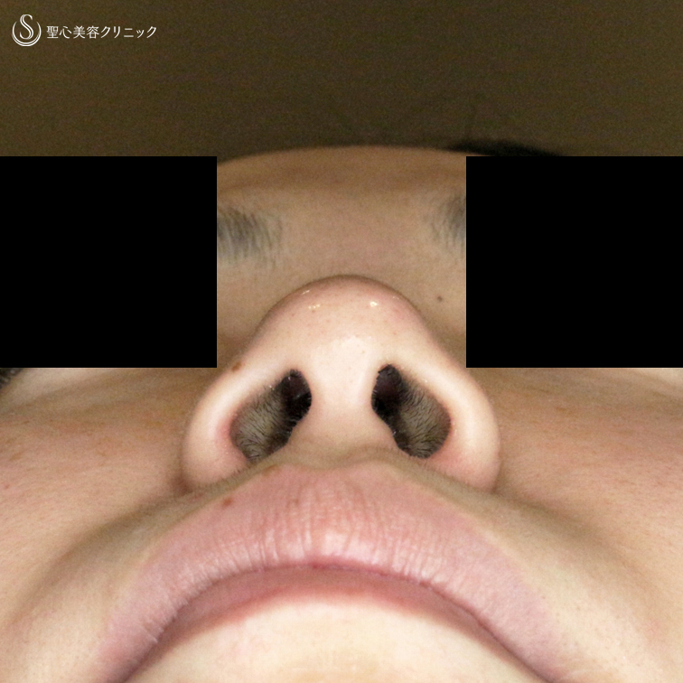 【20代女性・鼻の穴が見えない「忘れ鼻」に】小鼻縮小術+α法「Ver.5」（3年後） Before 