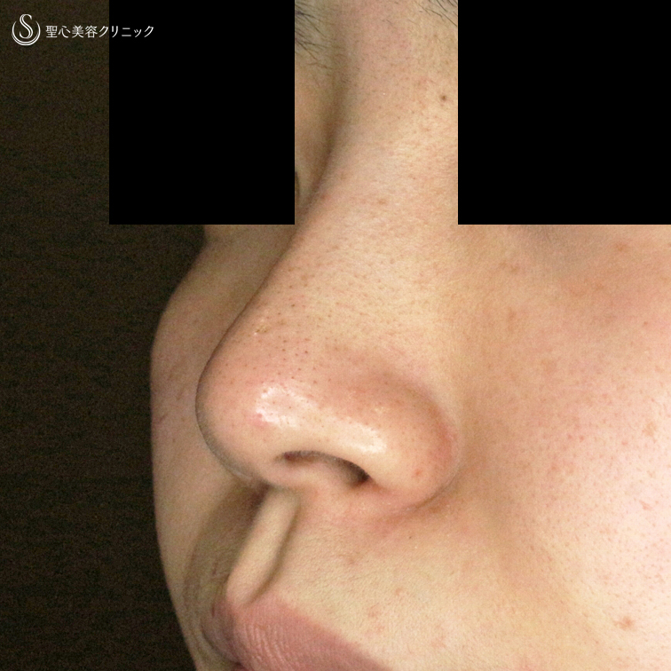 【20代女性・鼻の穴が見えない「忘れ鼻」に】小鼻縮小術+α法「Ver.5」（3年後） Before 
