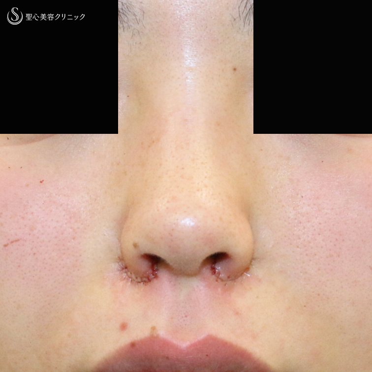 【20代女性・鼻の穴が見えない「忘れ鼻」に】小鼻縮小術+α法「Ver.5」（3年後） After 