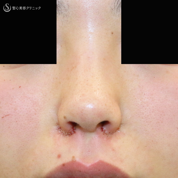 【20代女性・鼻の穴が見えない「忘れ鼻」へ】小鼻縮小術+α法「Ver.5」（4年後） After 