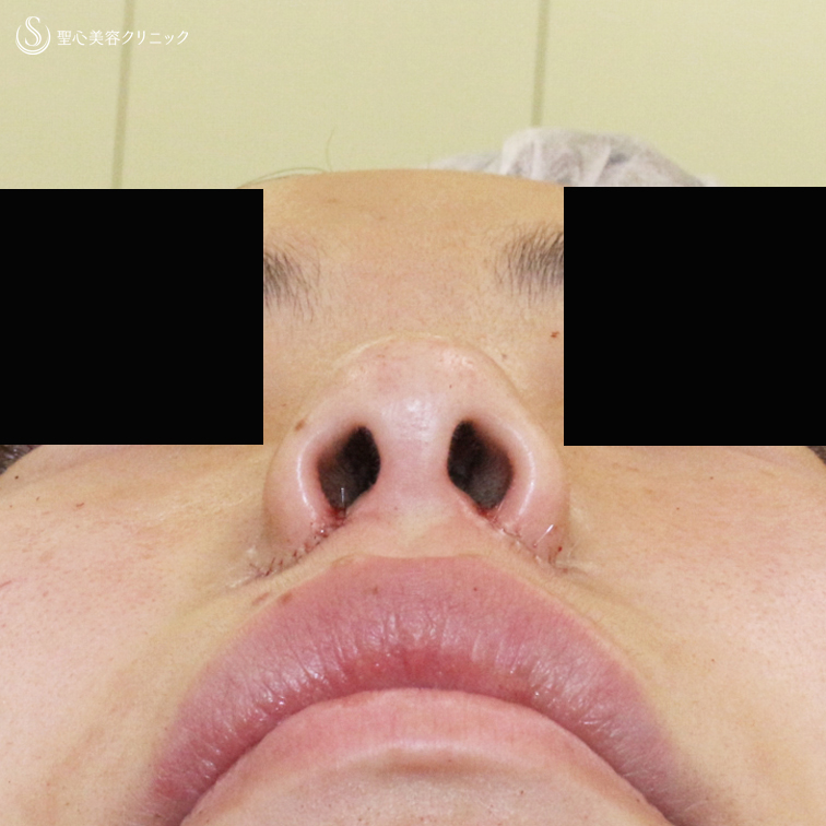 【20代女性・鼻の穴が見えない「忘れ鼻」へ】小鼻縮小術+α法「Ver.5」（4年後） After 