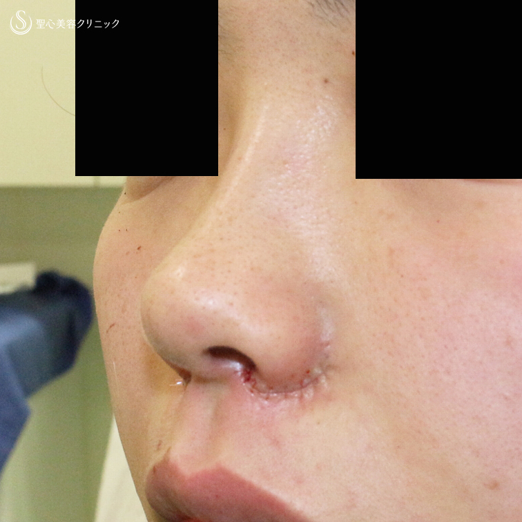 【20代女性・鼻の穴が見えない「忘れ鼻」へ】小鼻縮小術+α法「Ver.5」（4年後） After 