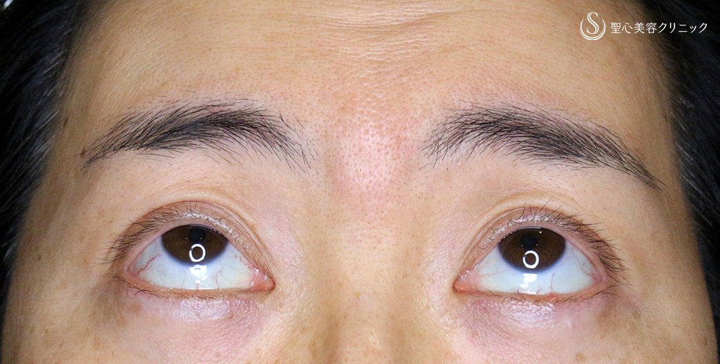 【40代女性・コンタクトレンズ眼瞼下垂にお勧め】切らない眼瞼下垂+α法（術直後〜1年後） Before 