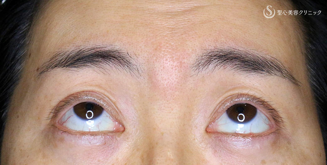 【40代女性・コンタクトレンズ眼瞼下垂にお勧め】切らない眼瞼下垂+α法（術直後〜1年後） Before 