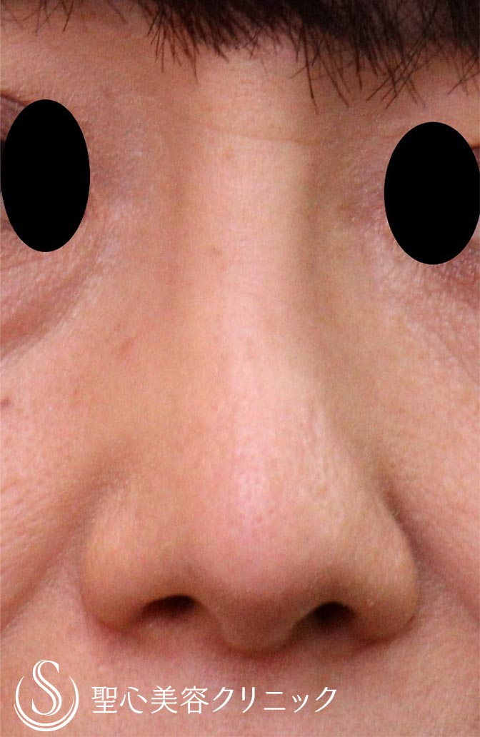 【50代女性・鼻】プロテーゼ抜去（1ヶ月後） Before 