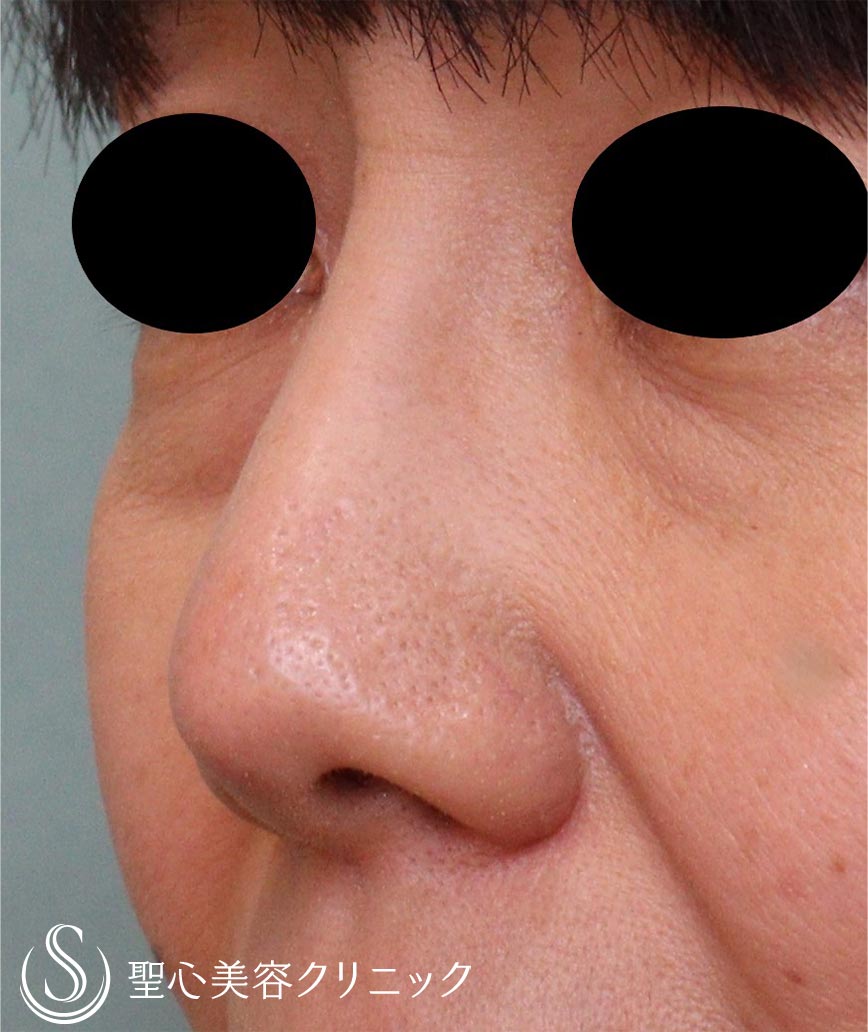 【50代女性・鼻】プロテーゼ抜去（1ヶ月後） Before 