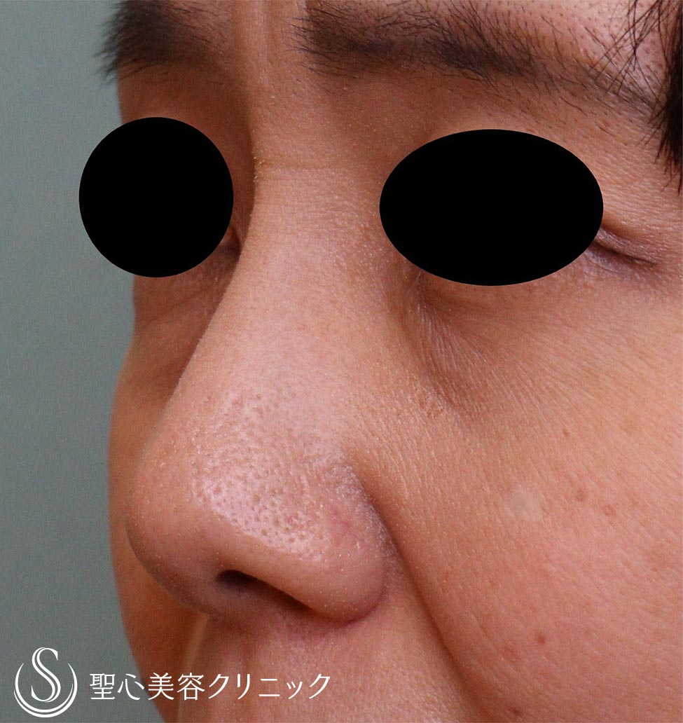 【50代女性・鼻】プロテーゼ抜去（1ヶ月後） After 