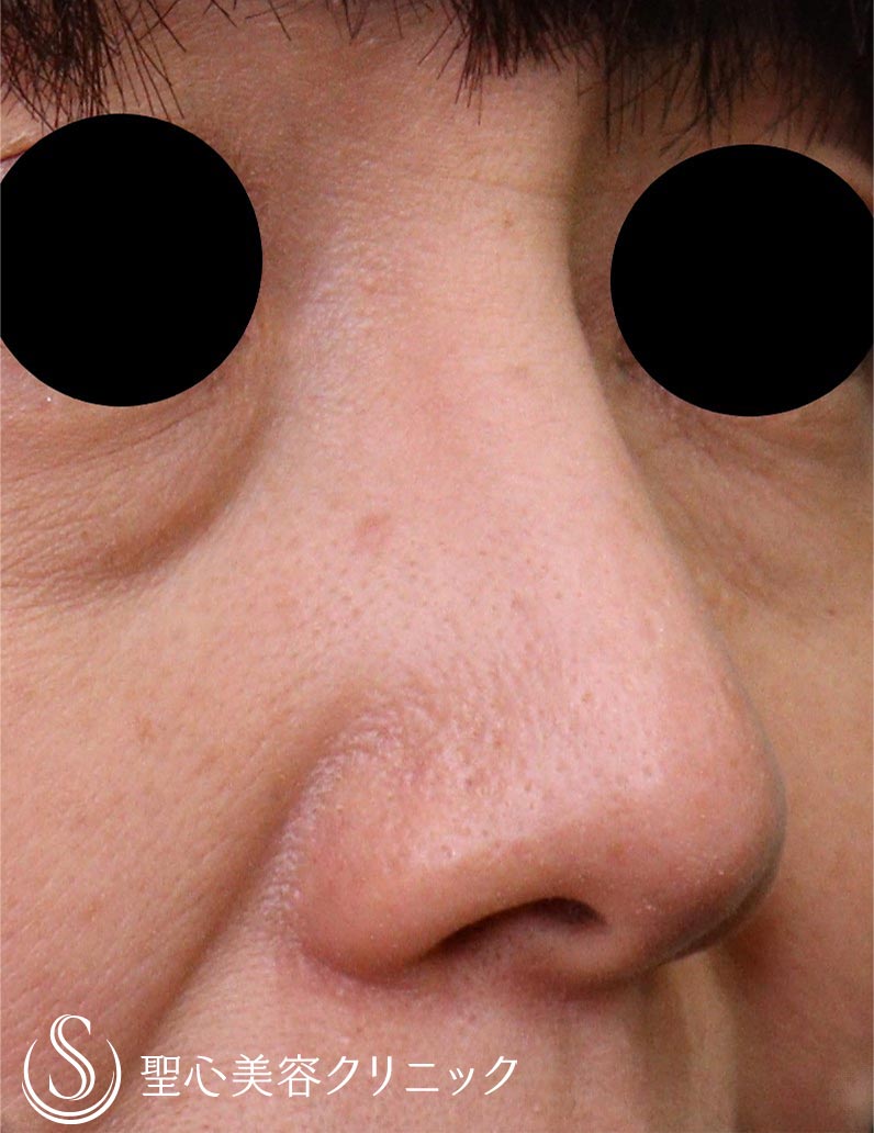 【50代女性・鼻】プロテーゼ抜去（1ヶ月後） Before 