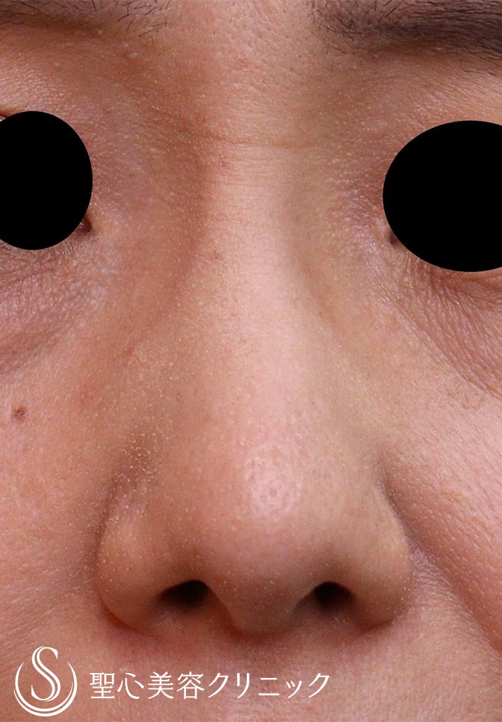 【50代女性・鼻】プロテーゼ抜去（1ヶ月後） After 