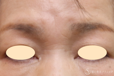 【60代女性・眉間～鼻根のしわ】プレミアムPRP皮膚再生療法（9ヶ月後） Before 