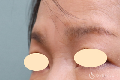 【60代女性・眉間～鼻根のしわ】プレミアムPRP皮膚再生療法（9ヶ月後） Before 