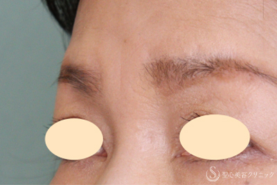 【60代女性・眉間～鼻根のしわ】プレミアムPRP皮膚再生療法（9ヶ月後） After 