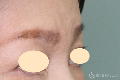 【60代女性・眉間～鼻根のしわ】プレミアムPRP皮膚再生療法（9ヶ月後） After 