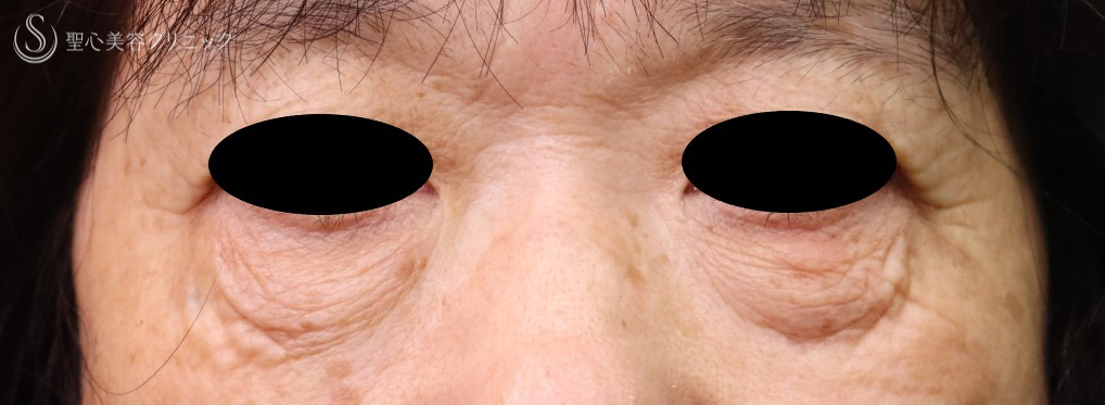 【70代女性・目の下のくま、しわ】プレミアムPRP皮膚再生療法（1年9ヶ月後） Before 