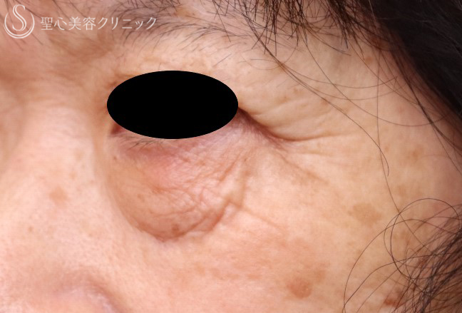【70代女性・目の下のくま、しわ】プレミアムPRP皮膚再生療法（1年9ヶ月後） Before 