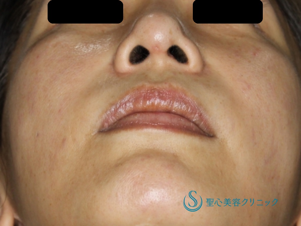 【40代女性・他院修正】他院鼻プロテーゼ後鼻尖縮小＋鼻尖形成（耳介軟骨移植）+プロテーゼ調整（１ヶ月後） After 