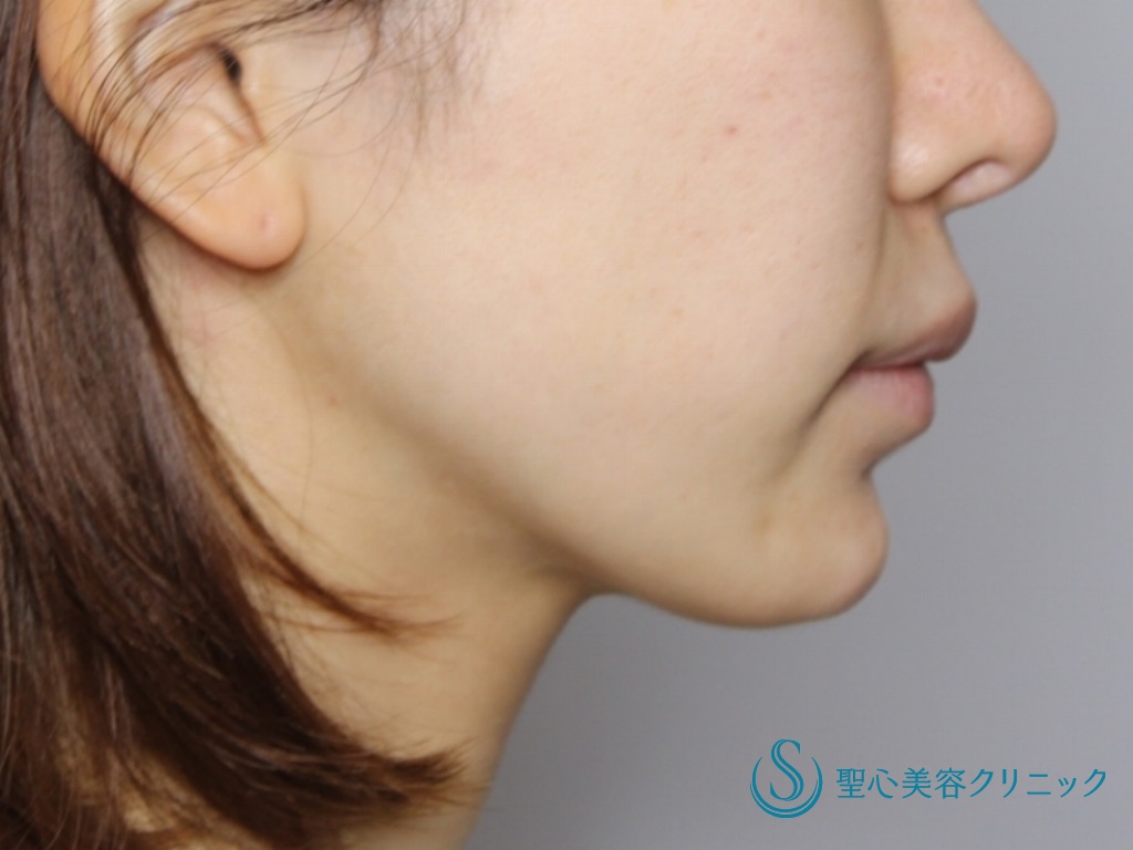 【20代女性・口元～フェイスラインのたるみを改善】フェイスリフト（1ヶ月後） Before 