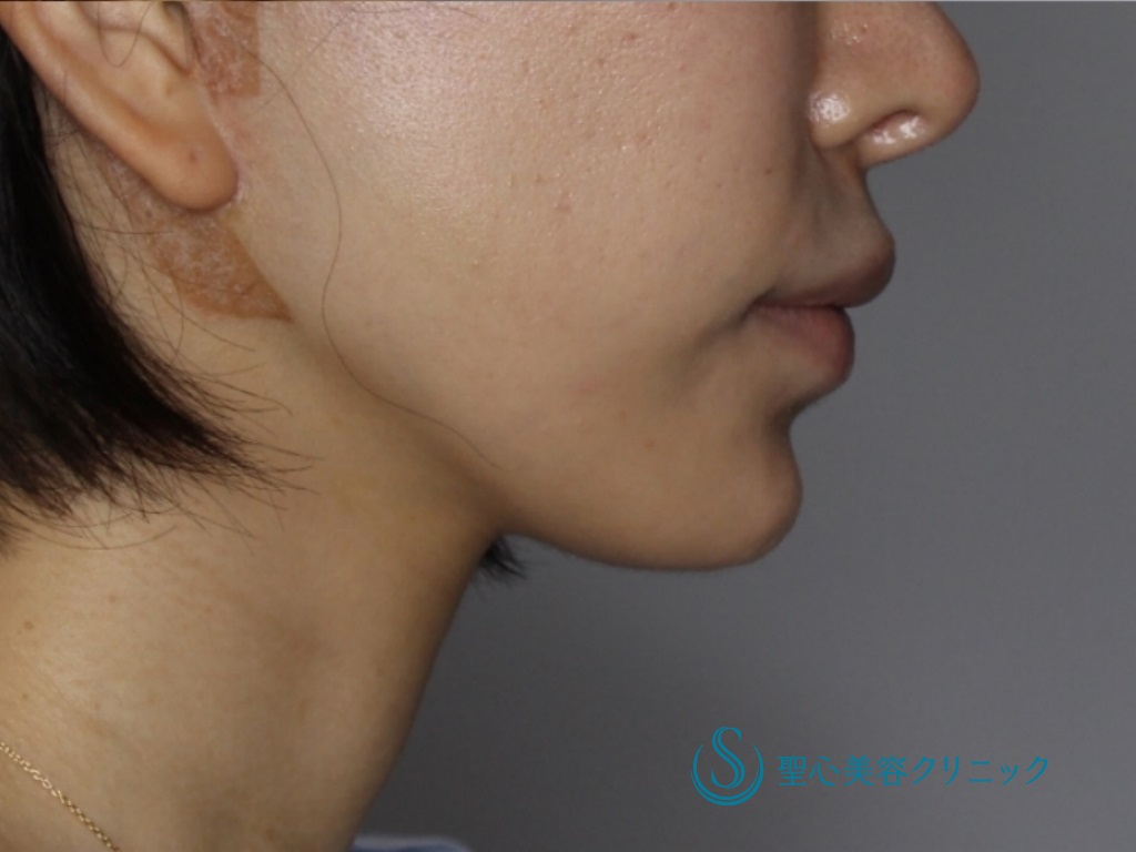 【20代女性・口元～フェイスラインのたるみを改善】フェイスリフト（1ヶ月後） After 